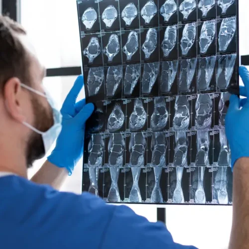 glioblastom-gbm-nedir-glioblastoma-belirtileri-nelerdir-g Glioblastom