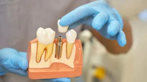 همه مراحل ایمپلنت دندان در ترکیه