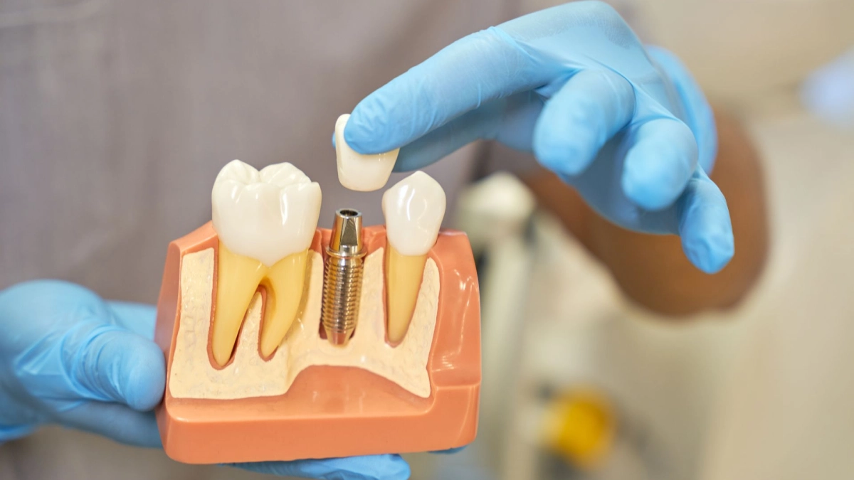 همه مراحل ایمپلنت دندان در ترکیه