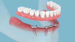 قیمت ایمپلنت دندان در استانبول