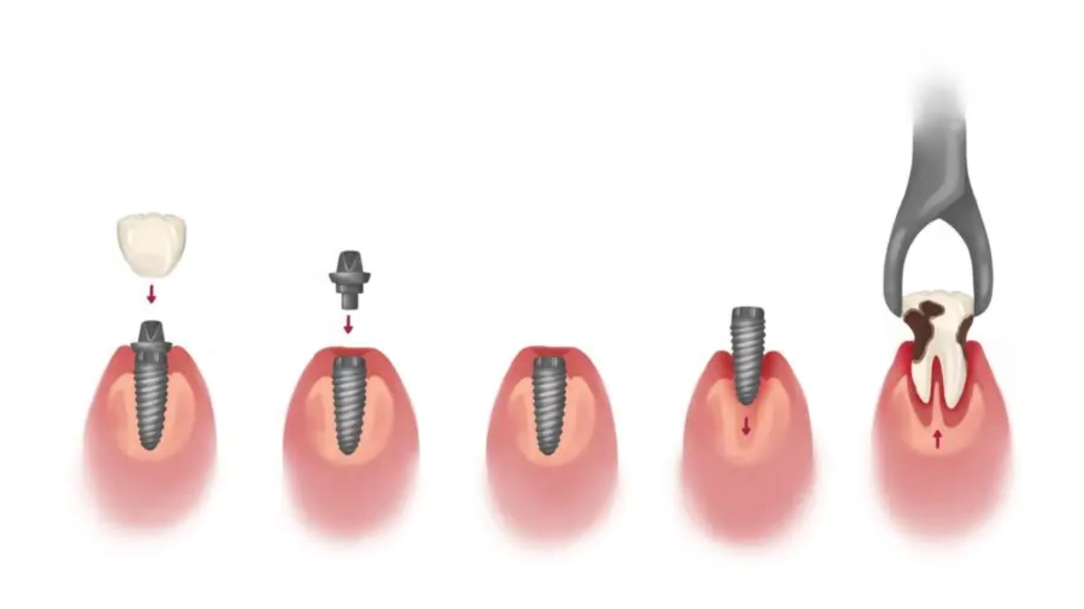 ایمپلنت دندان در استانبول