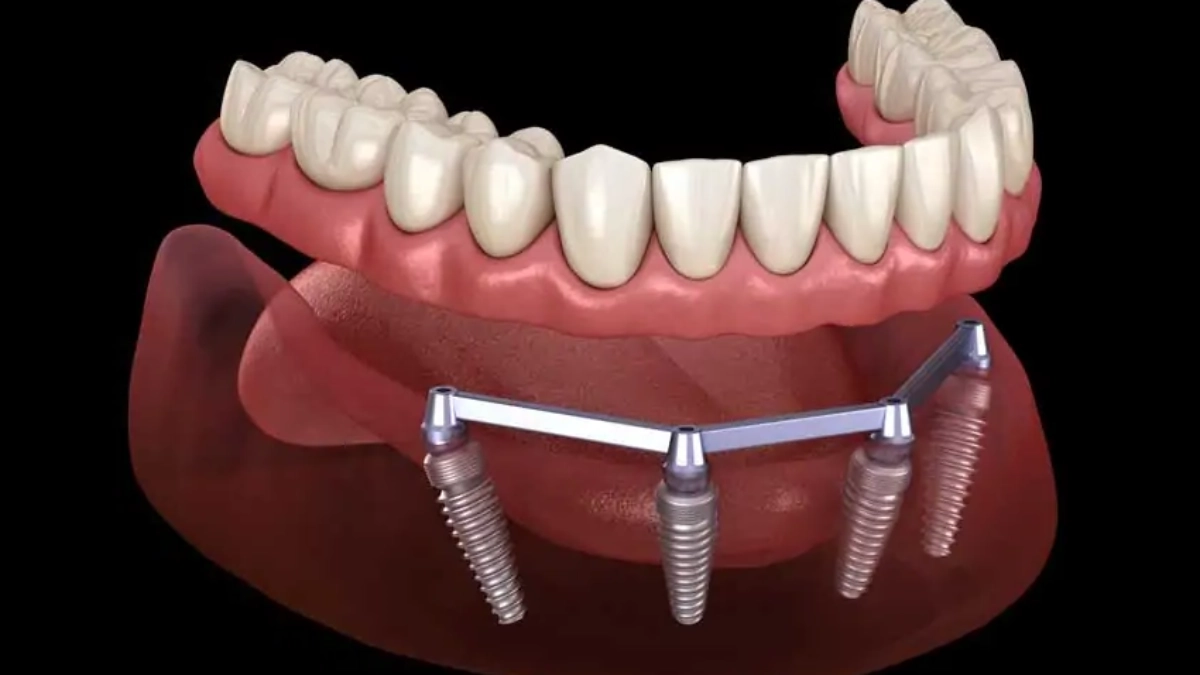 کاشت دندان طبیعی دائمی در استانبول