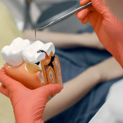 dis-dolgusundan-sonra-yemek-yerken-nelere-dikkat-edilmeli-g Diş Dolgusundan Sonra Yemek