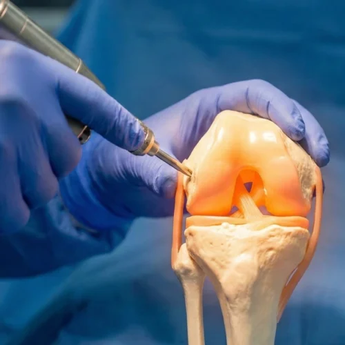 revision-knee-replacement-in-turkey Revision Knee Replacement in Turkey