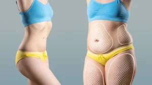 لیپوساکشن ۳۶۰ درجه در استانبول