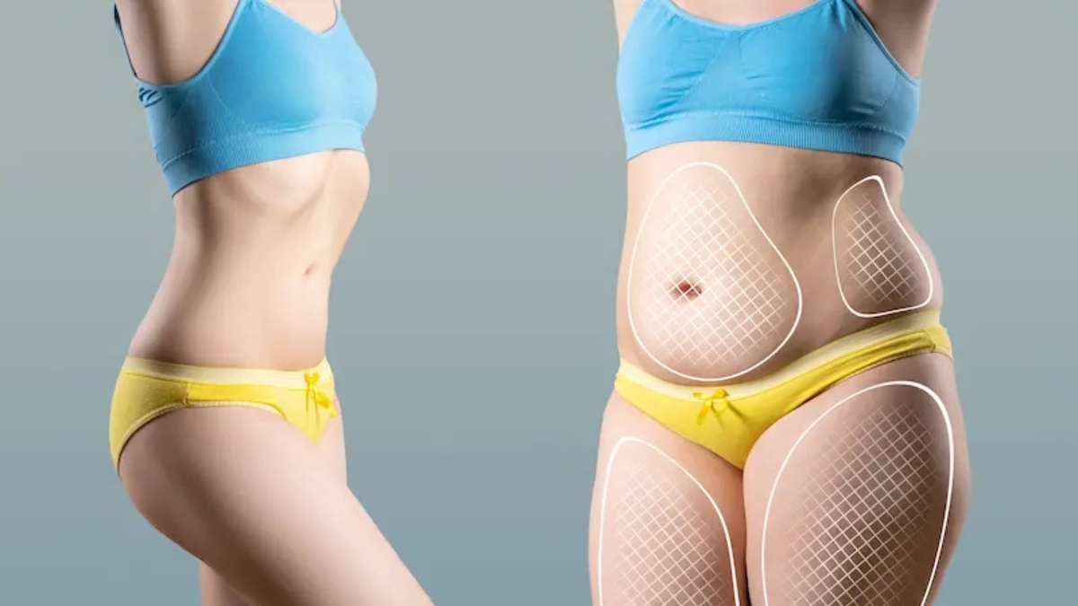 لیپوساکشن ۳۶۰ درجه در استانبول