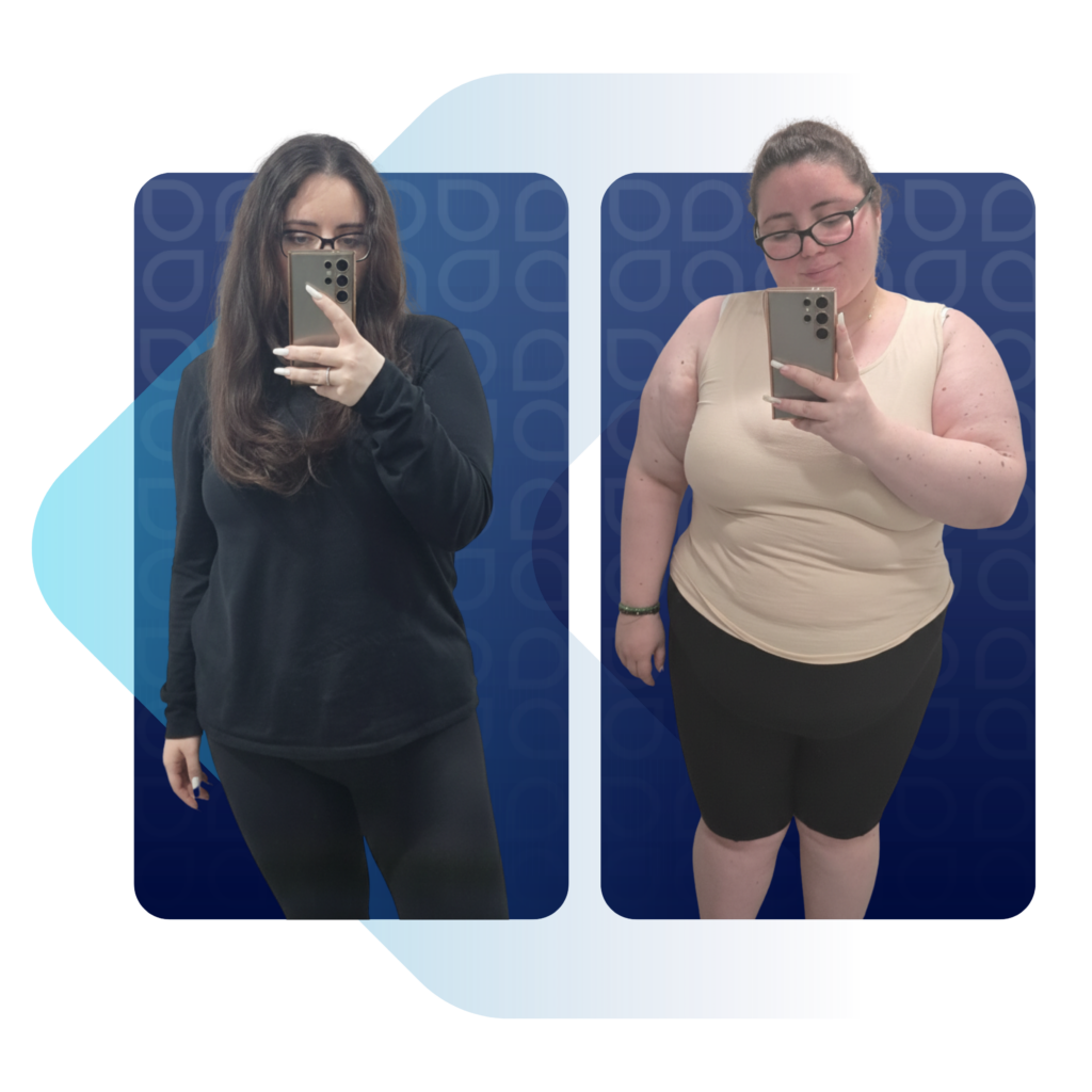 Obezite kilo kaybı sürecinde before after fiziksel değişim.