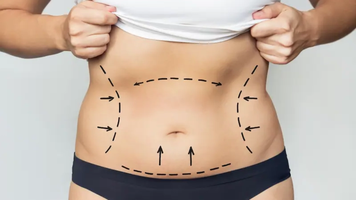 عمل‌های ابدومینوپلاستی و مینی ابدومینوپلاستی در استانبول