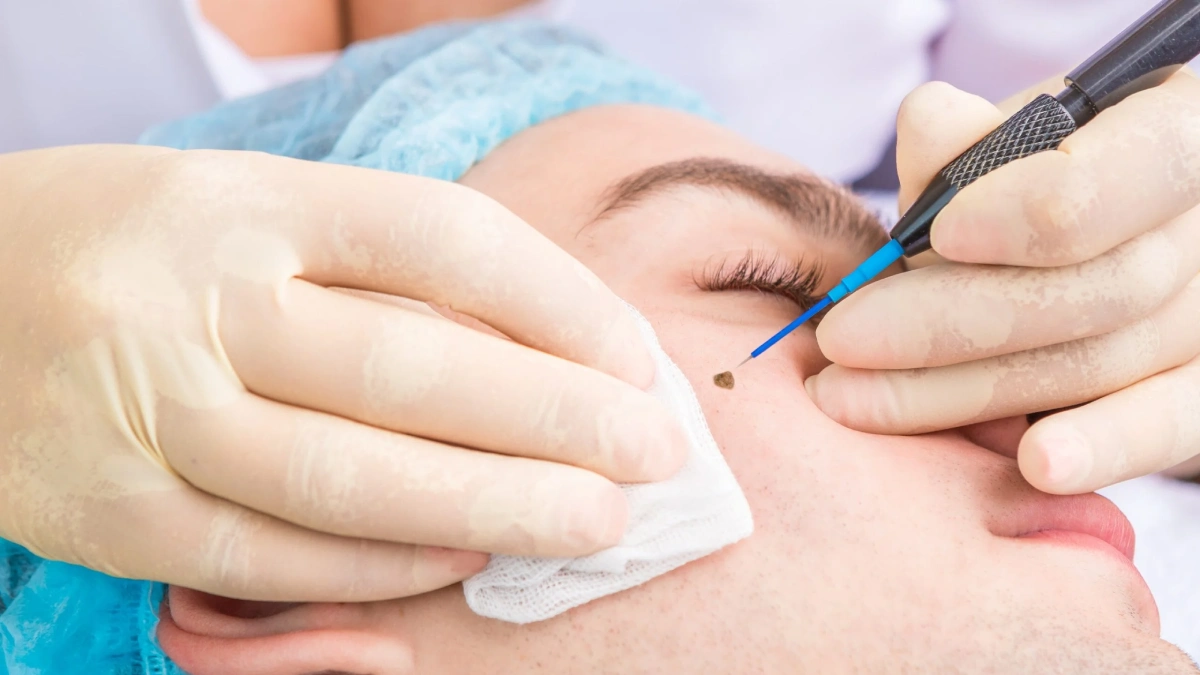 حذف خال و اسکار با لیزر در ترکیه