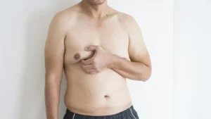 جراحی ژنیکوماستی مردان در استانبول