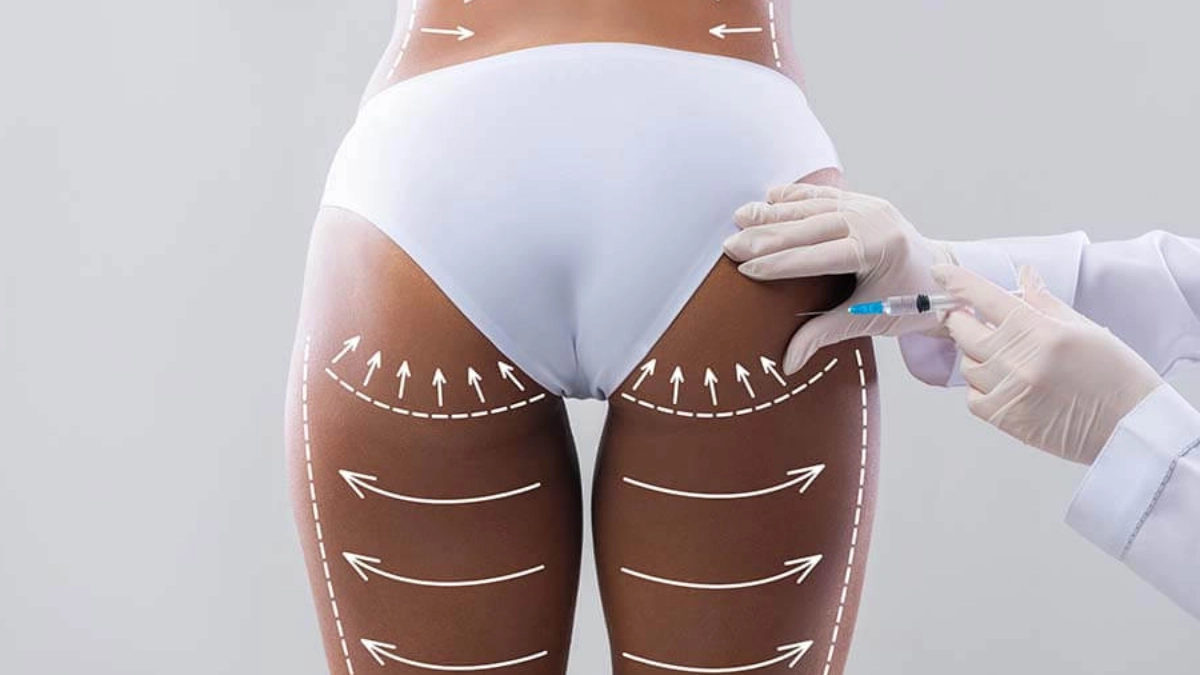 بهبودی پس از BBL: نکات مهم مراقبتی بعد از عمل در ترکیه