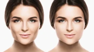 پیچکتومی برداشتن چربی گونه در ترکیه