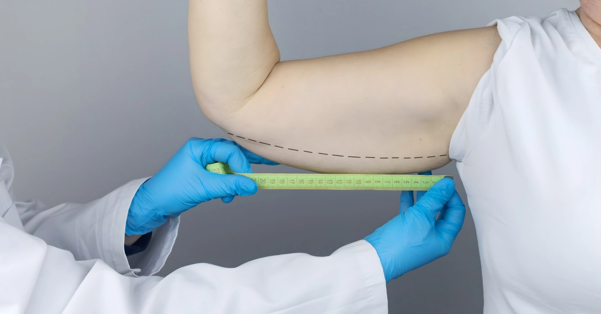 Kol ve bacak germe operasyonu sonrası sıkı ve estetik vücut görünümü sağlayan estetik cerrahi uygulama