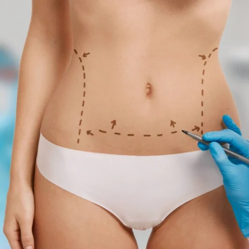 Tummy Tuck vs. Mini Tummy Tuck in Turkey