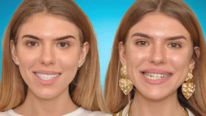 جراحی ترکیب فیس لیفت و لمینت دندان در ترکیه