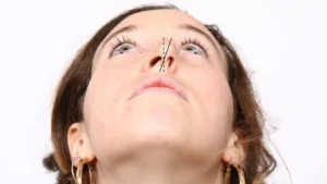 جراحی سپتوپلاستی در ترکیه در استانبول