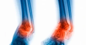 Osteomyelitis treatment in Turkey