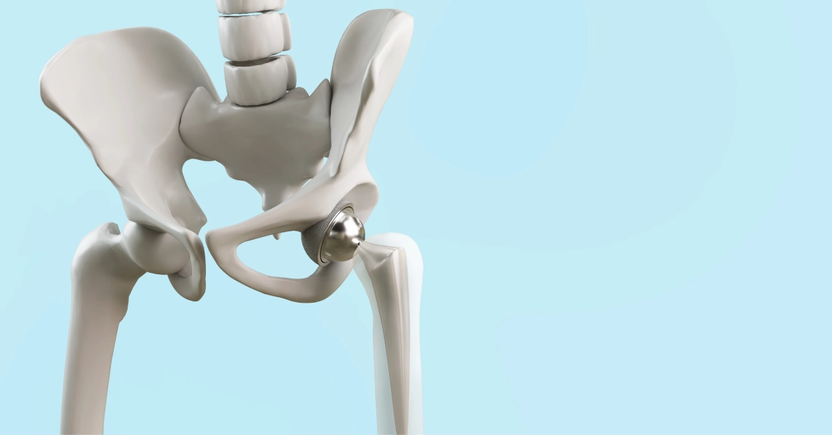 Advanced robotic surgery for hip replacement in Istanbul