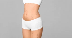 Vaser liposuction, ultrasonik teknoloji ile yağ dokusunun şekillendirilmesini amaçlayan estetik uygulamalardan biridir.